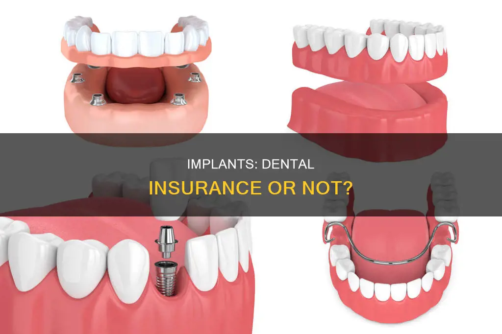 are implants considered dentures insurance