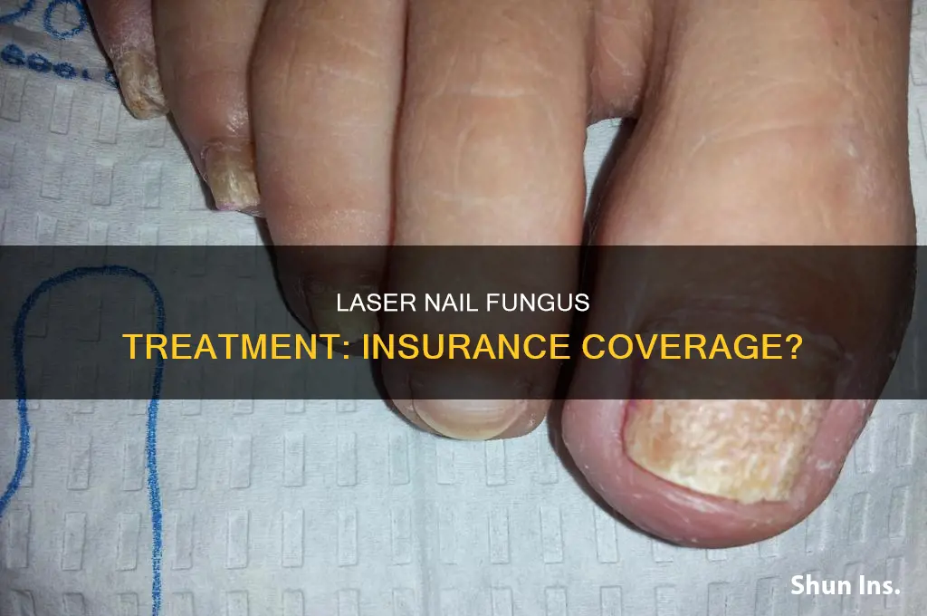 are laser treatments for nail fungus billable to insurance