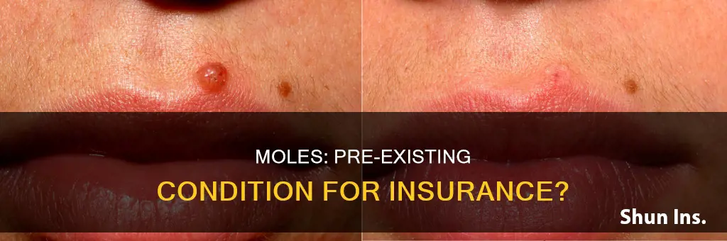 are moles considered preexisting condition for insurance