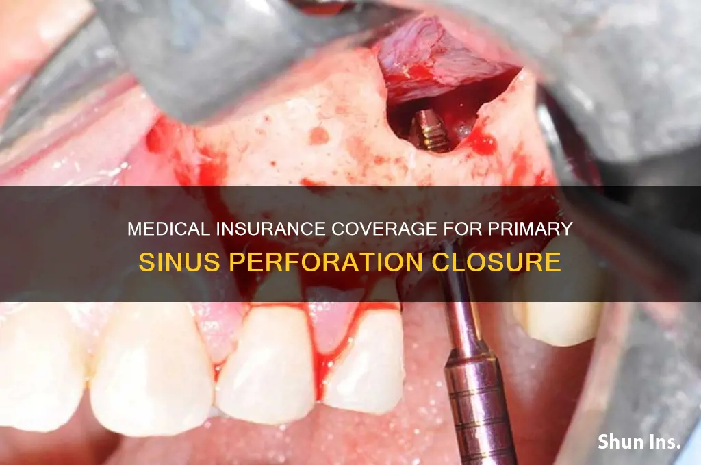 can my medical insurance cover primary closure sinus perforation