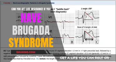 Life Insurance with Brugada Syndrome: Is It Possible?