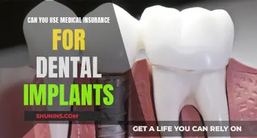 Dental Implants: Using Medical Insurance for Coverage