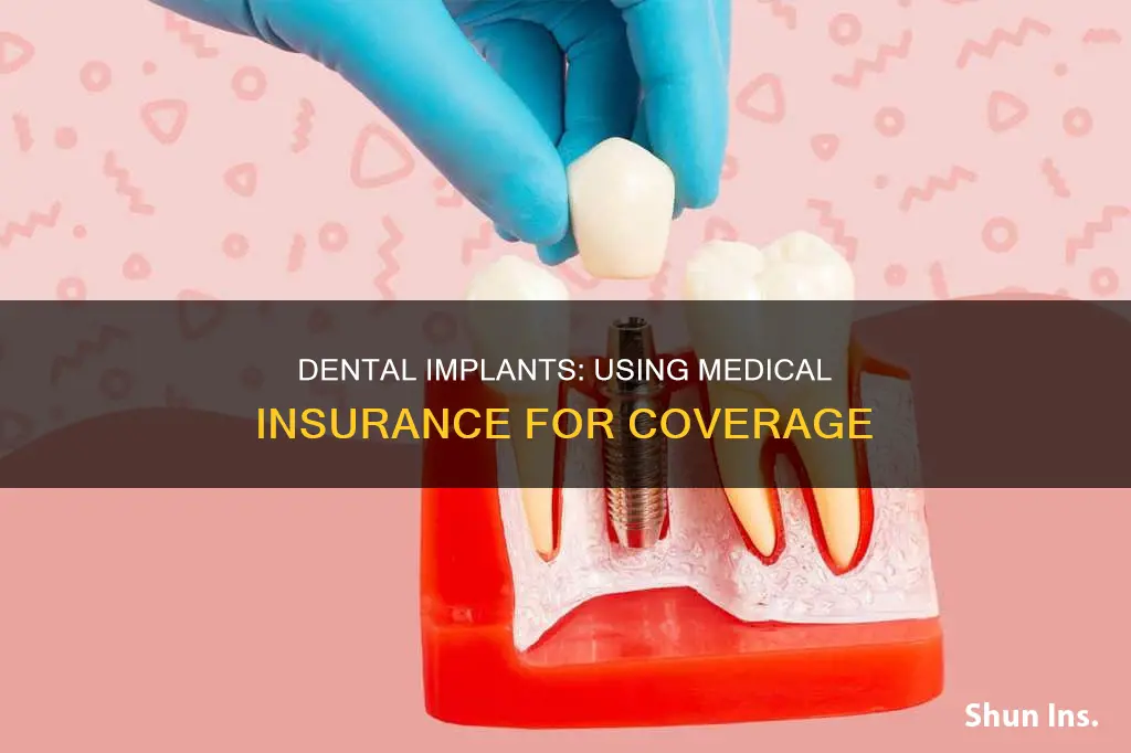 can you use medical insurance for dental implants