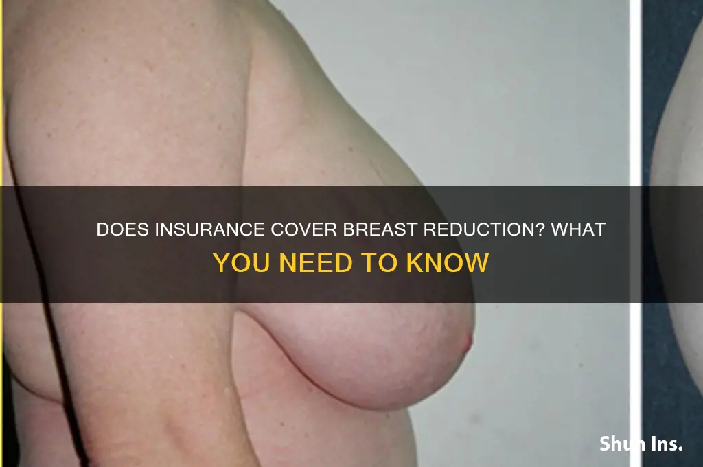 do breast reductions civer by insurance