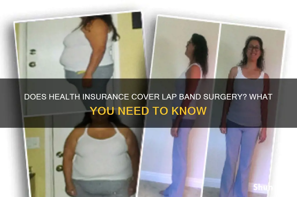 do health insurance cover lap band surgery