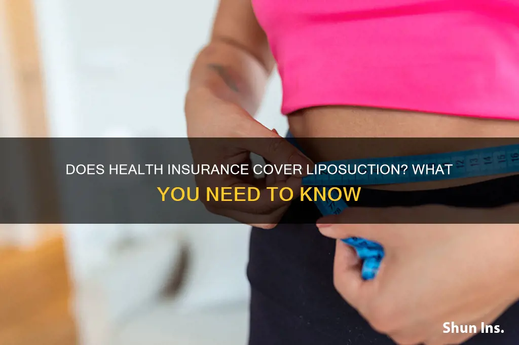 do health insurance cover liposuction