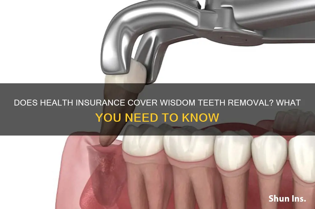 do health insurance cover wisdom teeth removal