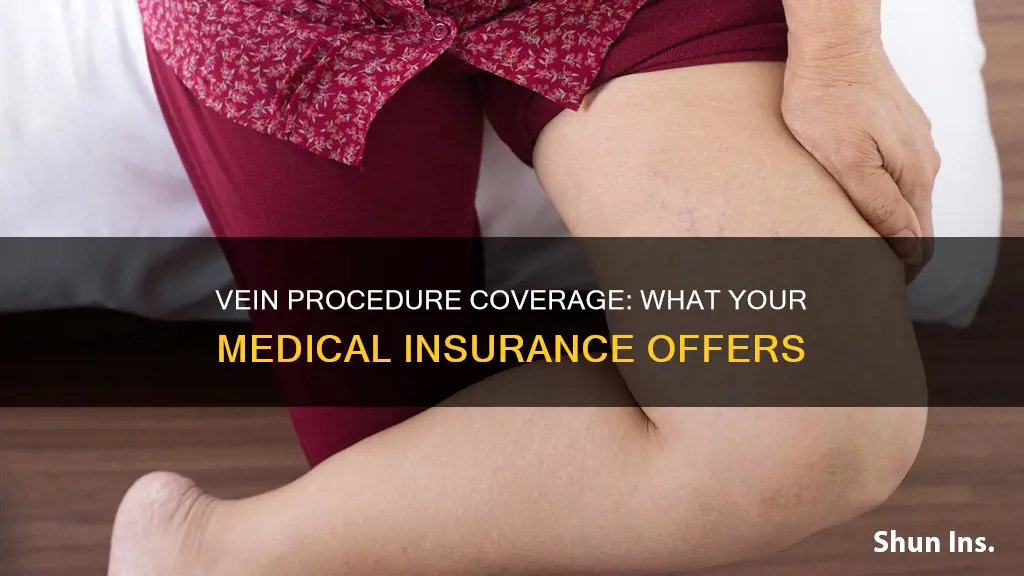 do medical insurance companies cover vein procedures