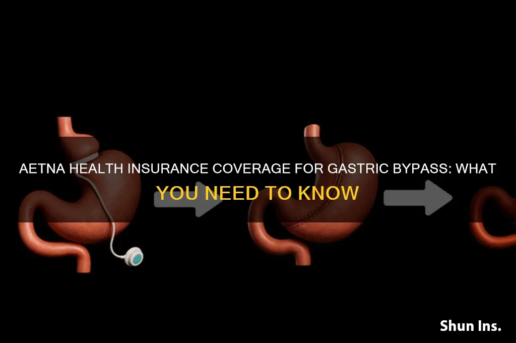 does aetna health insurance cover gastric bypass