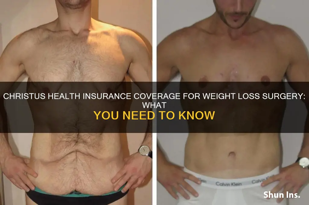 does christus health insurance cover weight loss surgery