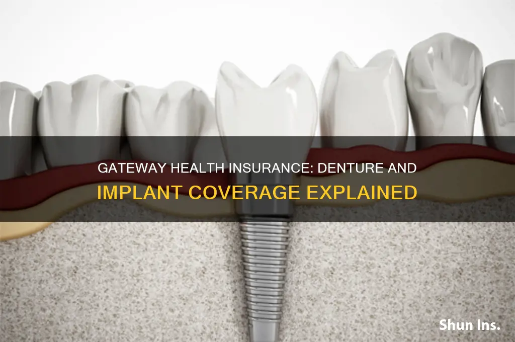 does gateway health insurance cover dentures or implants