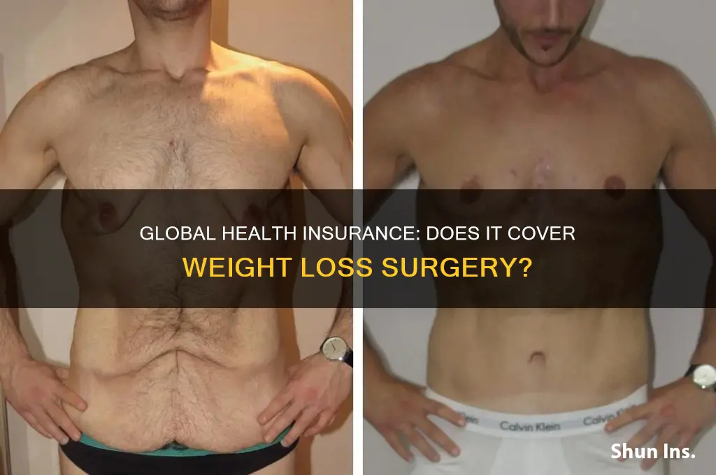 does global health insurance cover weight loss surgery