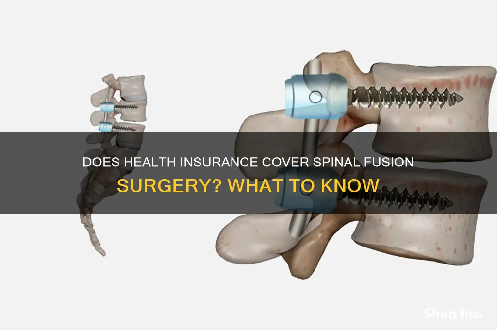 does health insurance cover a fusion
