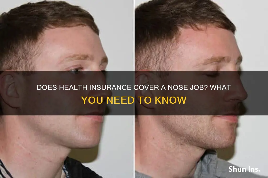 does health insurance cover a nose job