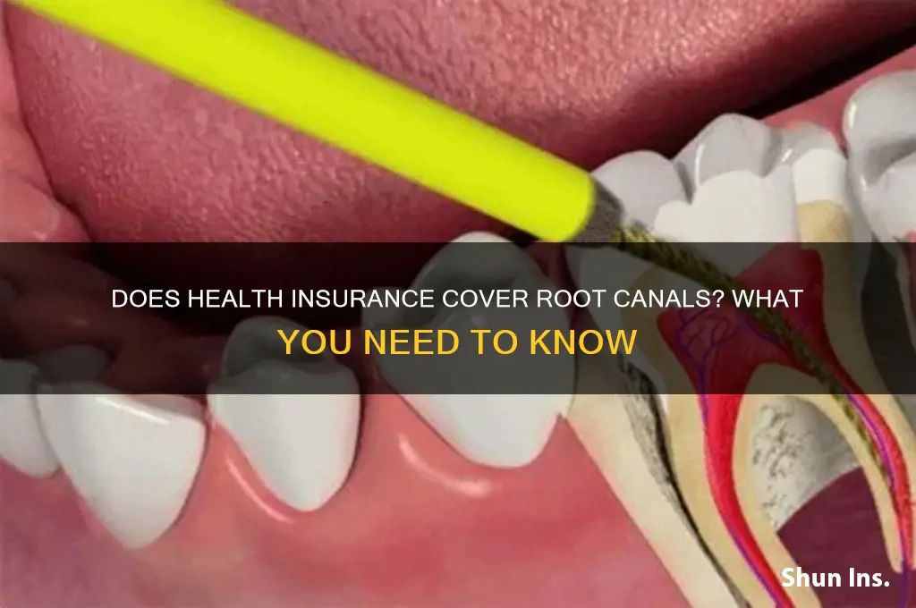 does health insurance cover a root canal
