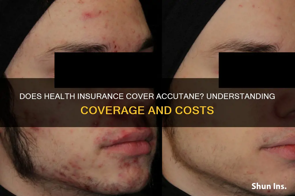 does health insurance cover accutane