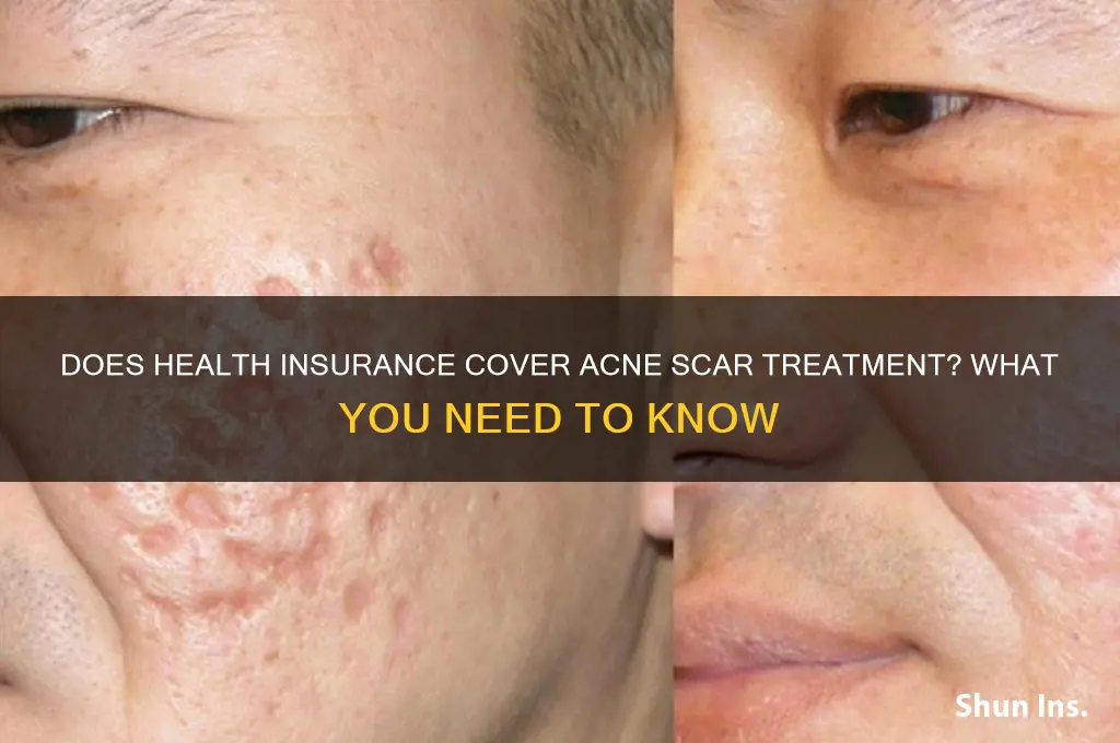 does health insurance cover acne scar treatment