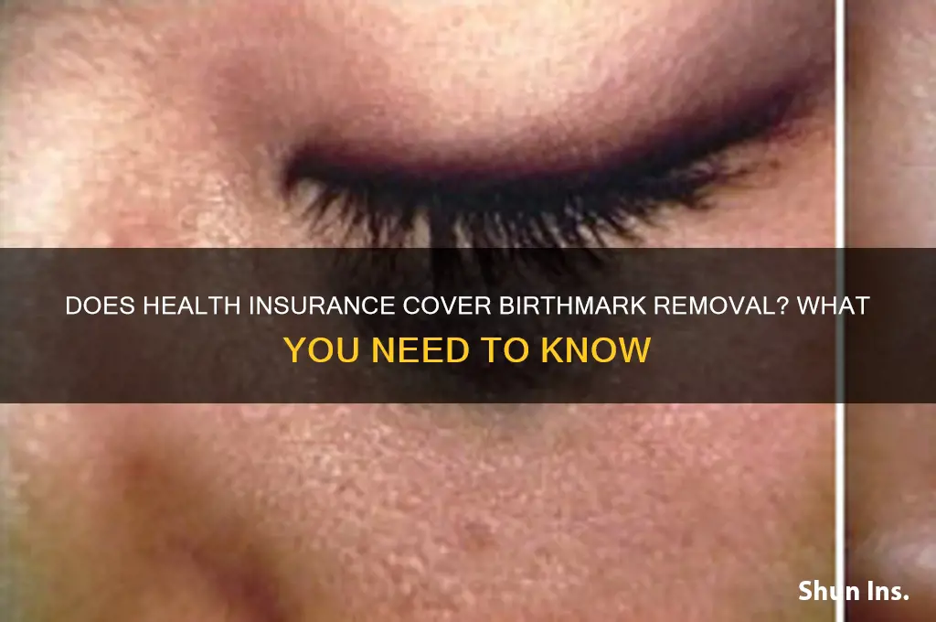does health insurance cover birthmark removal