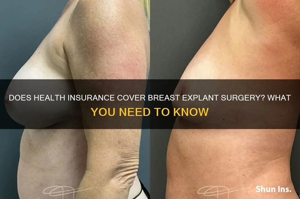 does health insurance cover breast explantation