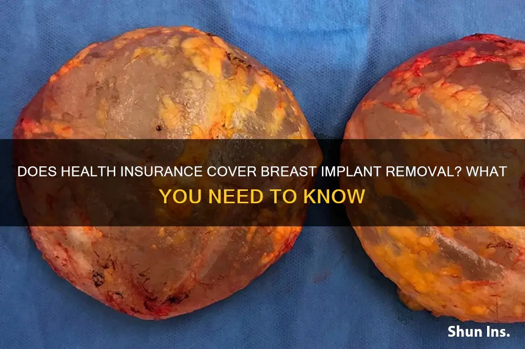 does health insurance cover breast implant removal