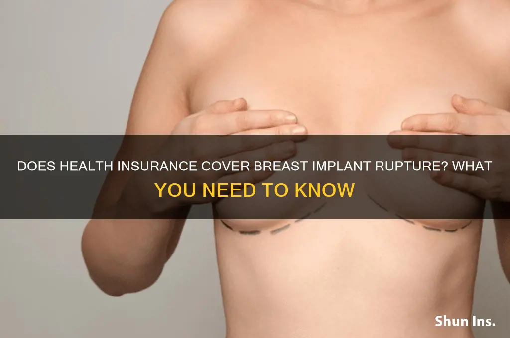 does health insurance cover breast implant rupture