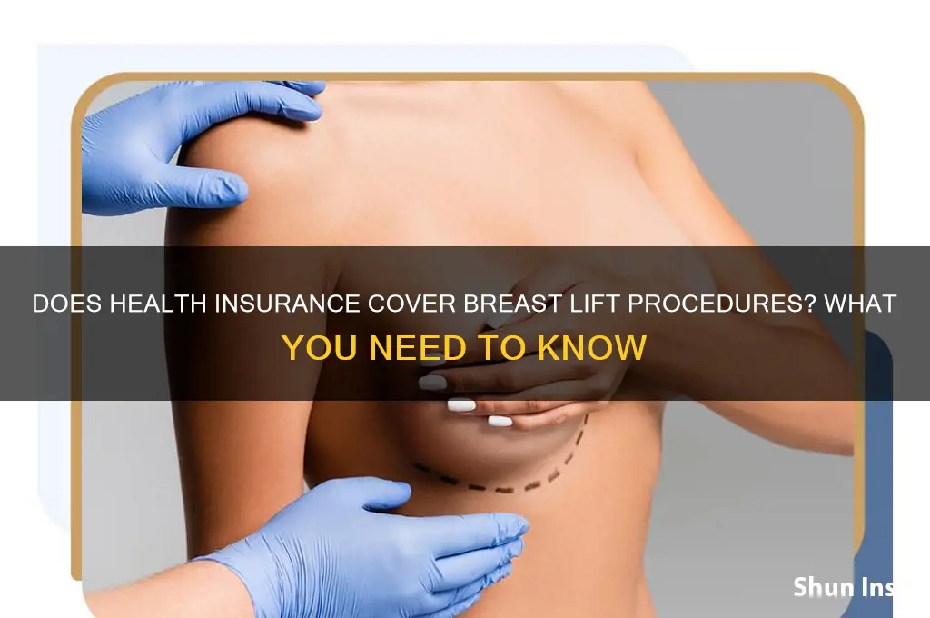 does health insurance cover breast lift