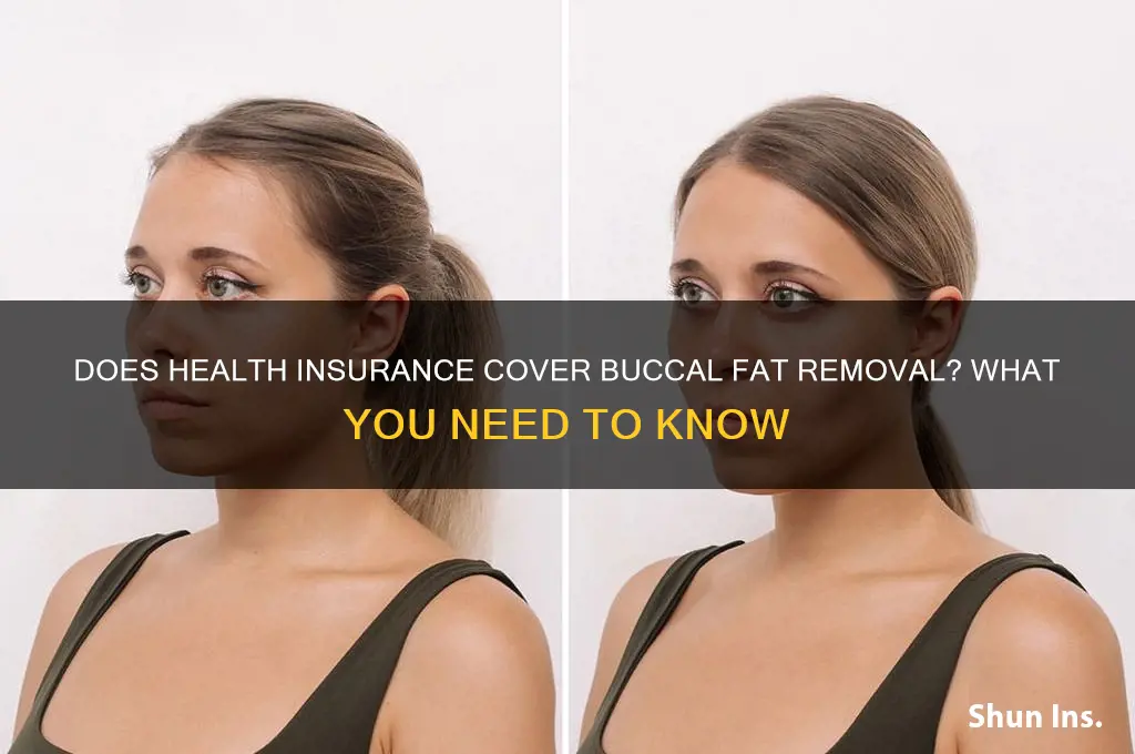 does health insurance cover buccal fat removal