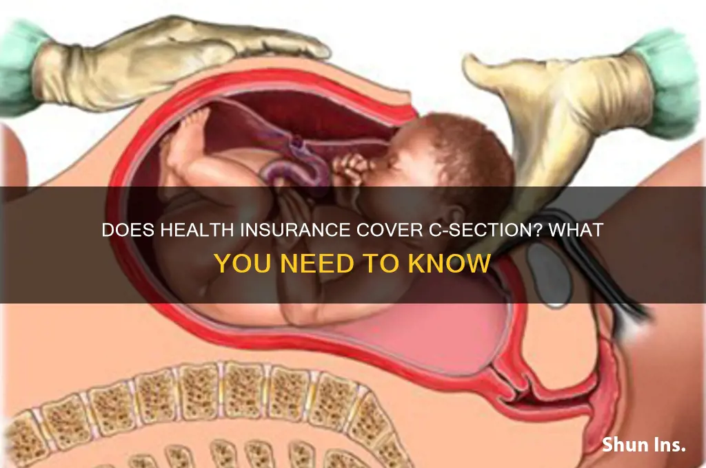 does health insurance cover c section