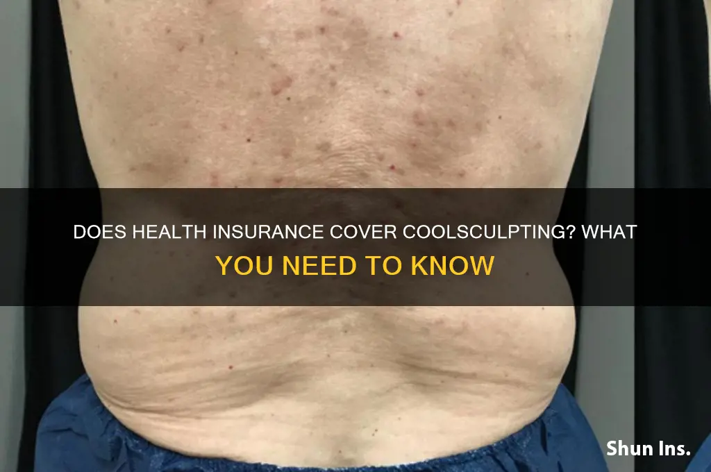 does health insurance cover coolsculpting