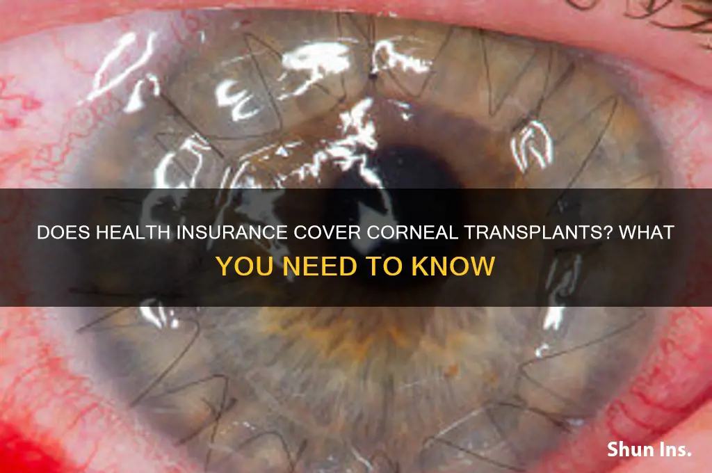 does health insurance cover corneal transplants