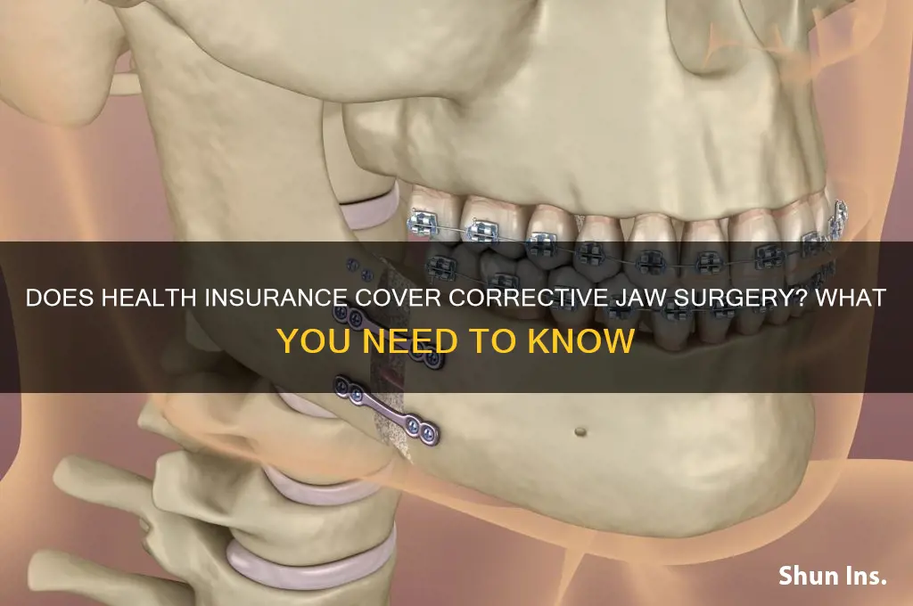 does health insurance cover corrective jaw surgery
