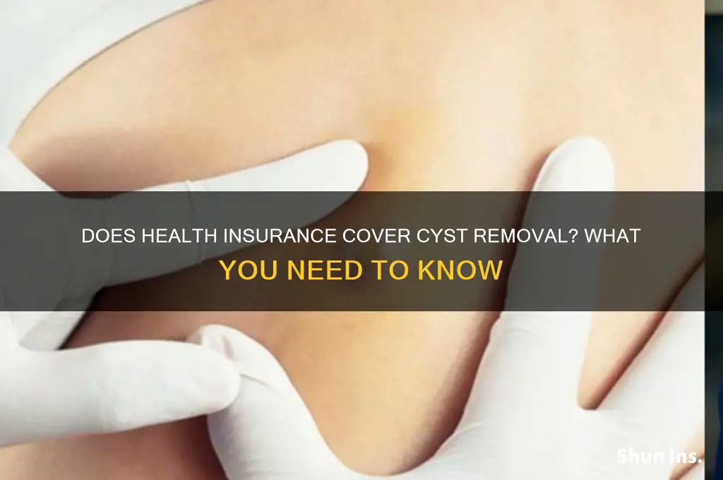 does health insurance cover cyst removal