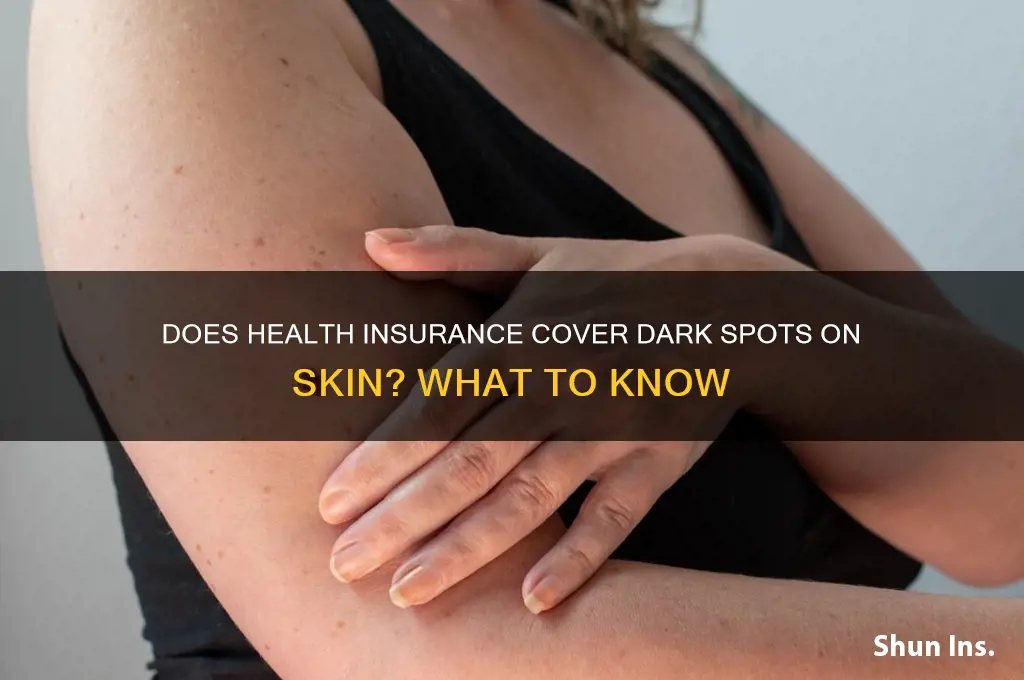 does health insurance cover dark spotson skin