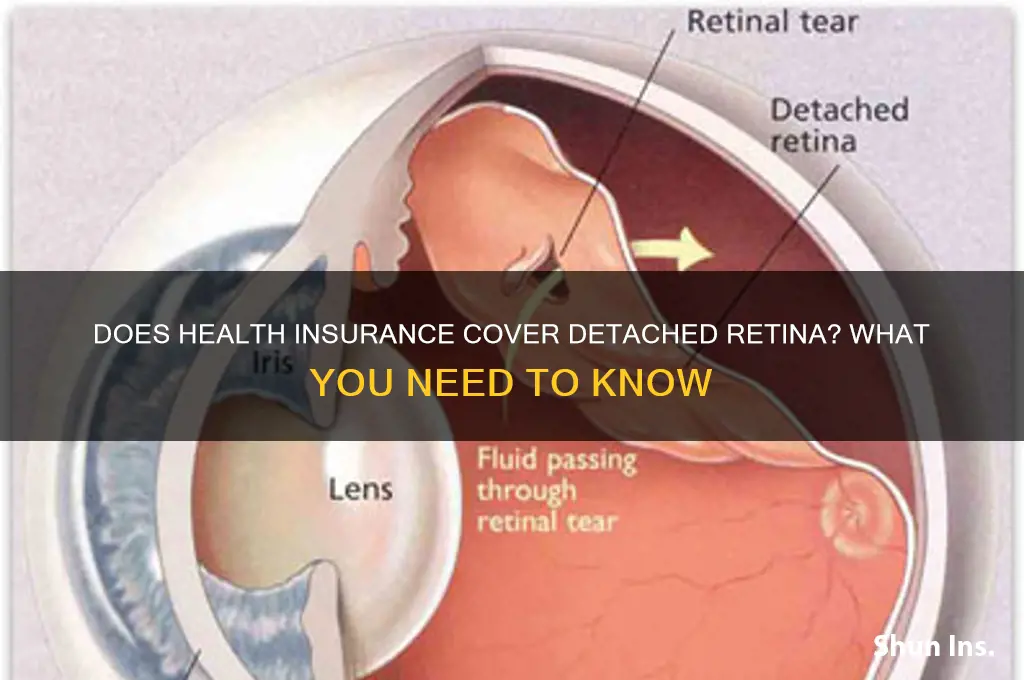 does health insurance cover detached retina