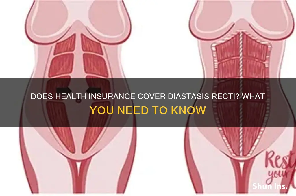 does health insurance cover diastasis recti