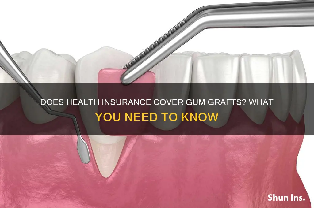 does health insurance cover dum grafts