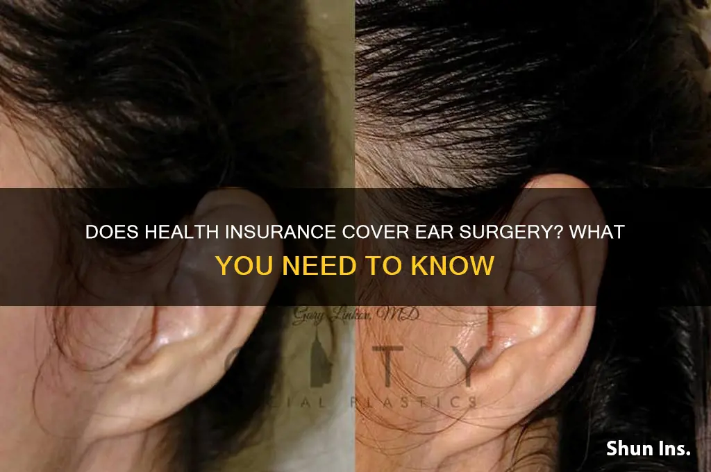 does health insurance cover ear surgery