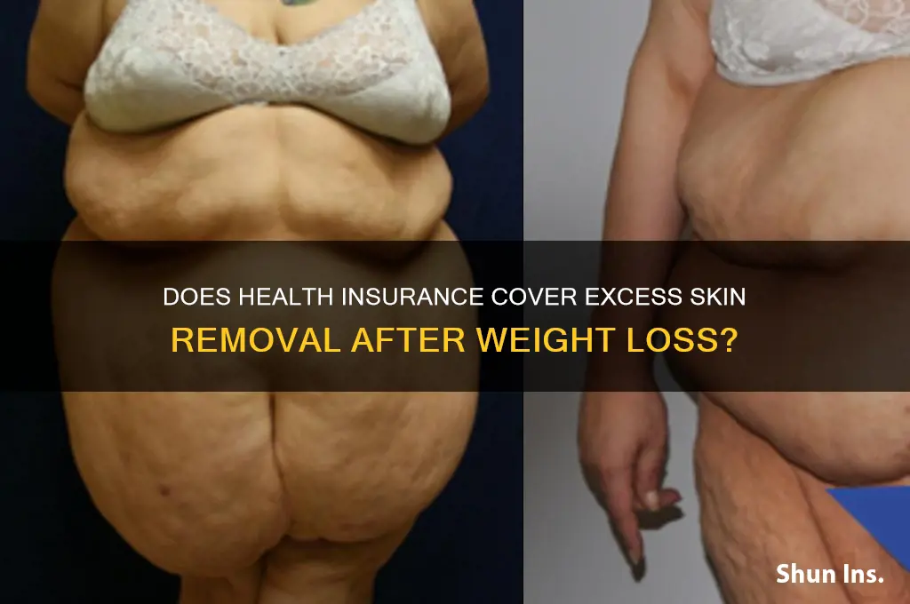 does health insurance cover excess skin removal