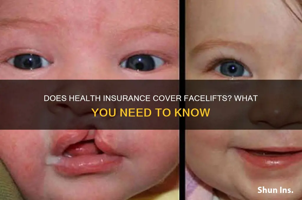 does health insurance cover facelifts
