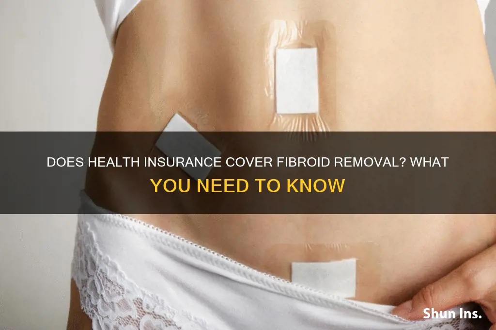 does health insurance cover fibroid removal