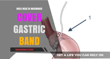 Does Health Insurance Cover Gastric Band Surgery? Key Facts Explained