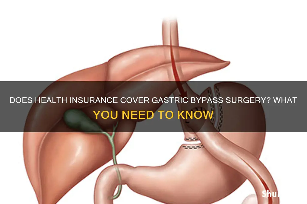does health insurance cover gastric bypass surgery
