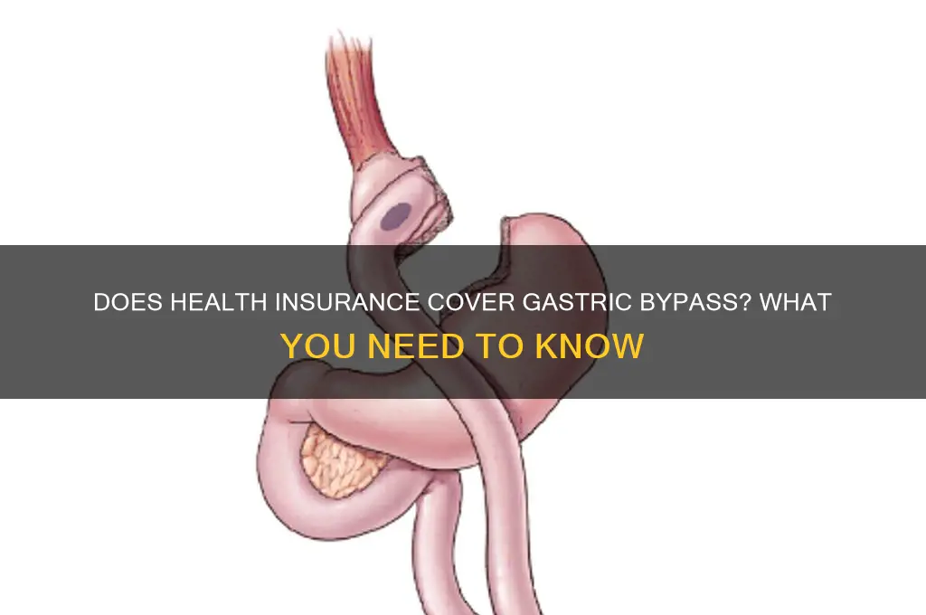 does health insurance cover gastric bypass