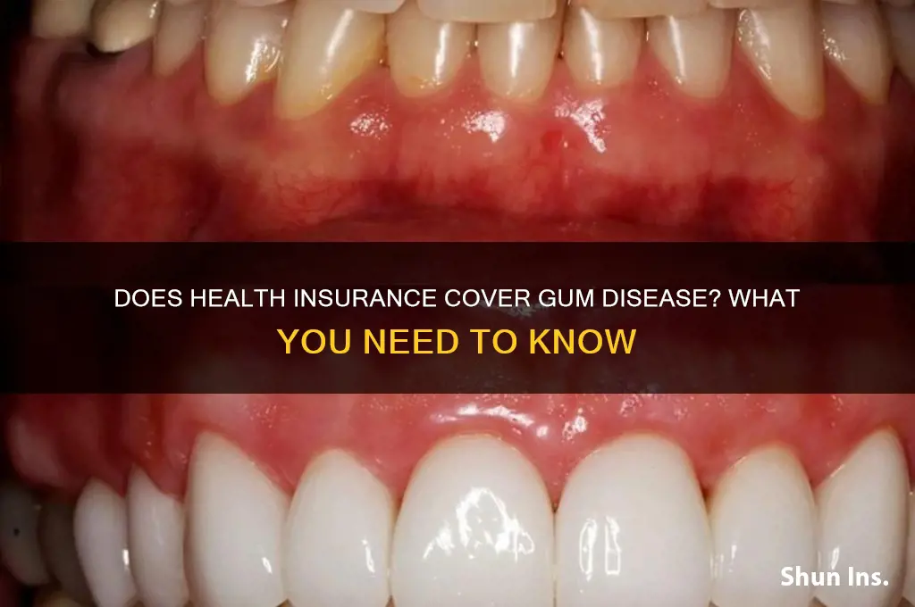 does health insurance cover gum disease