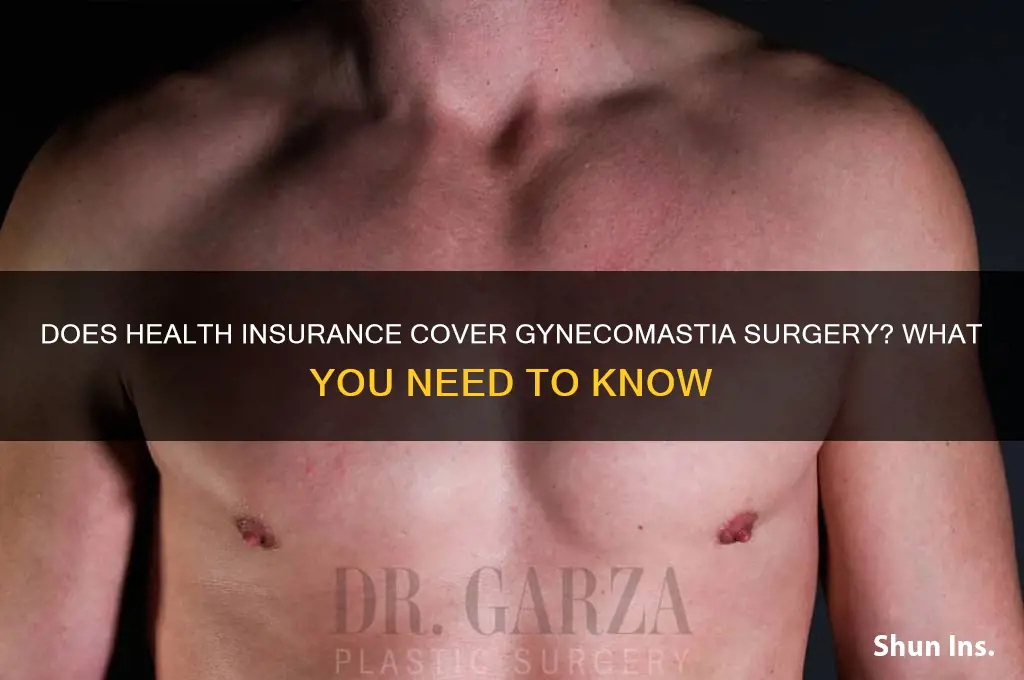 does health insurance cover gynecomastia surgery