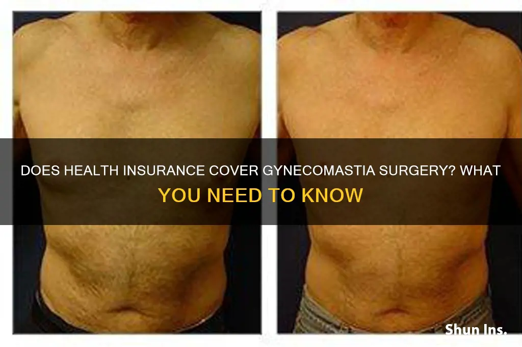 does health insurance cover gyno surgery