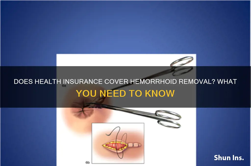 does health insurance cover hemorrhoid removal
