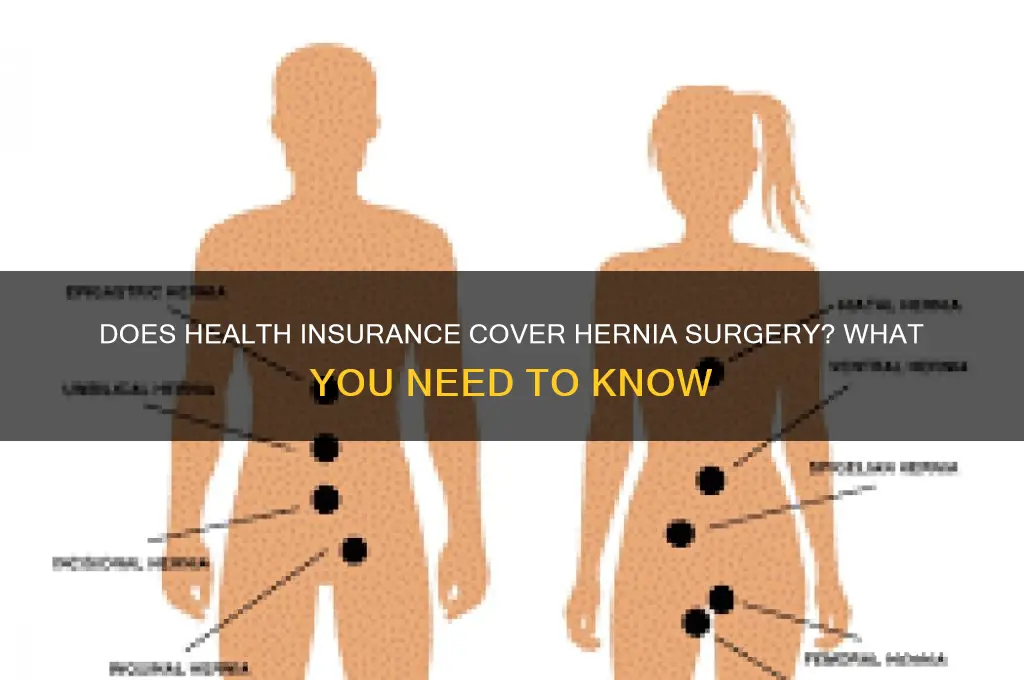 does health insurance cover hernia surgery