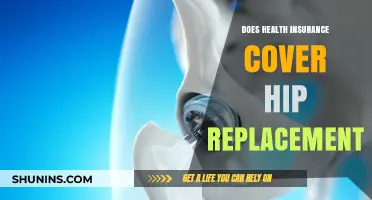 Does Health Insurance Cover Hip Replacement? What You Need to Know