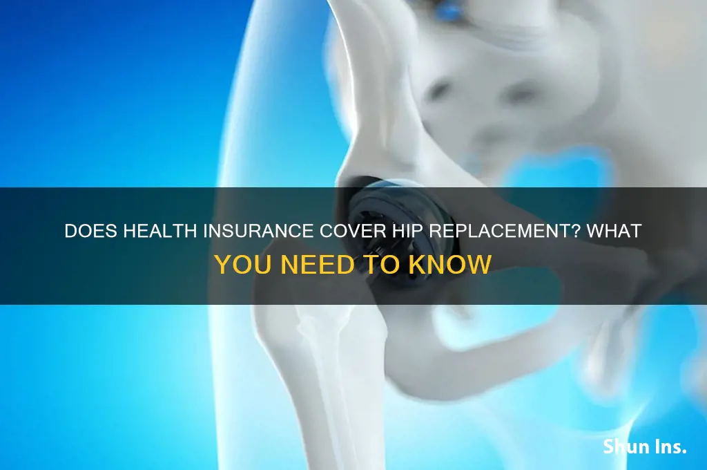does health insurance cover hip replacement